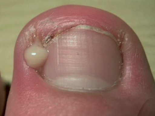 Infected-Ingrowing-Nail--2813004707.jpg