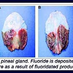 pineal gland fluoride.jpg