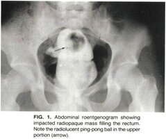 450px-1987_concrete_enema_x-ray.jpg